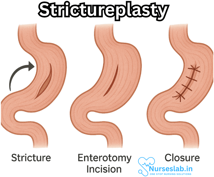 Strictureplasty
