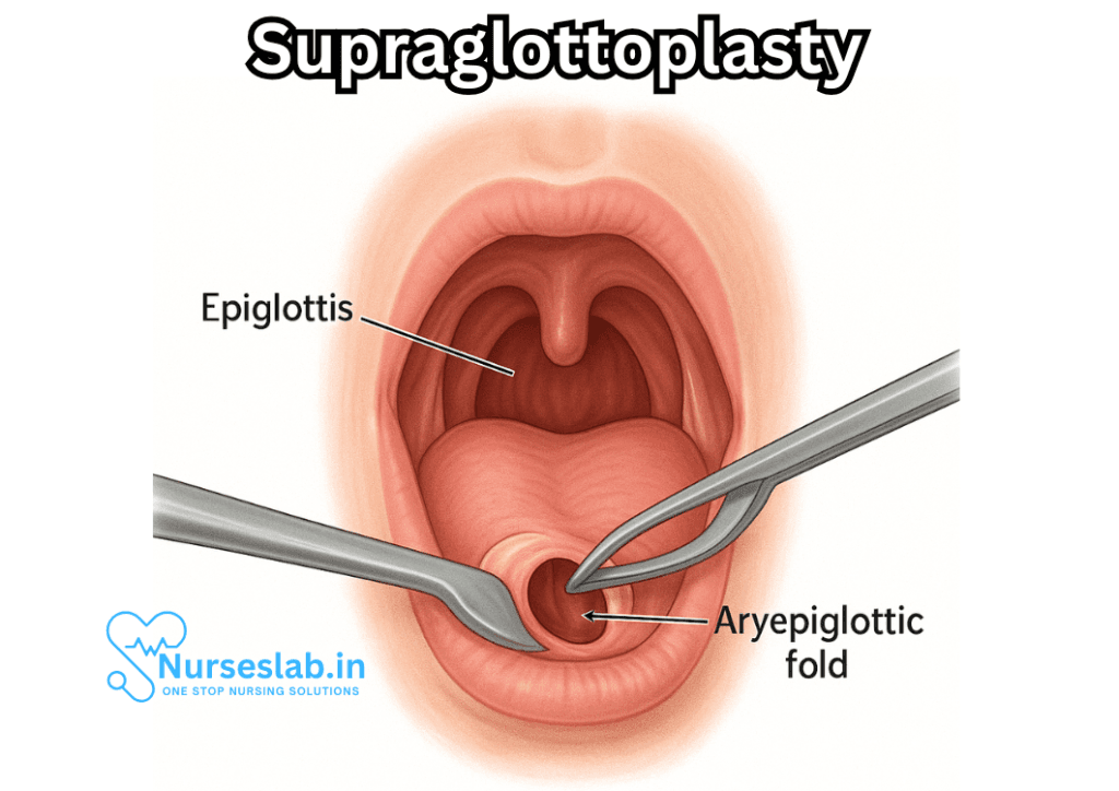 Supraglottoplasty