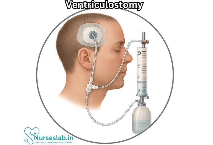 Ventriculostomy