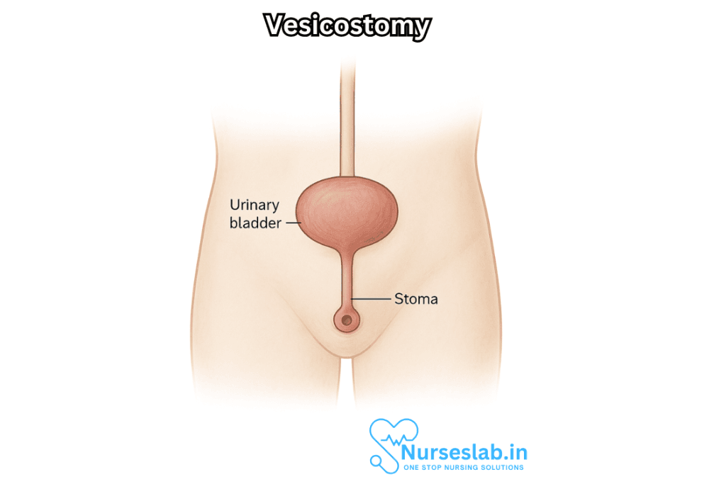 Vesicostomy