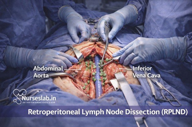 Retroperitoneal Lymph Node Dissection